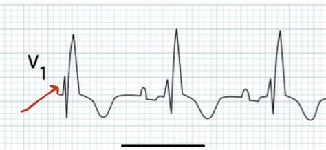 Explain the first R wave in this RBBB? : r/ECG