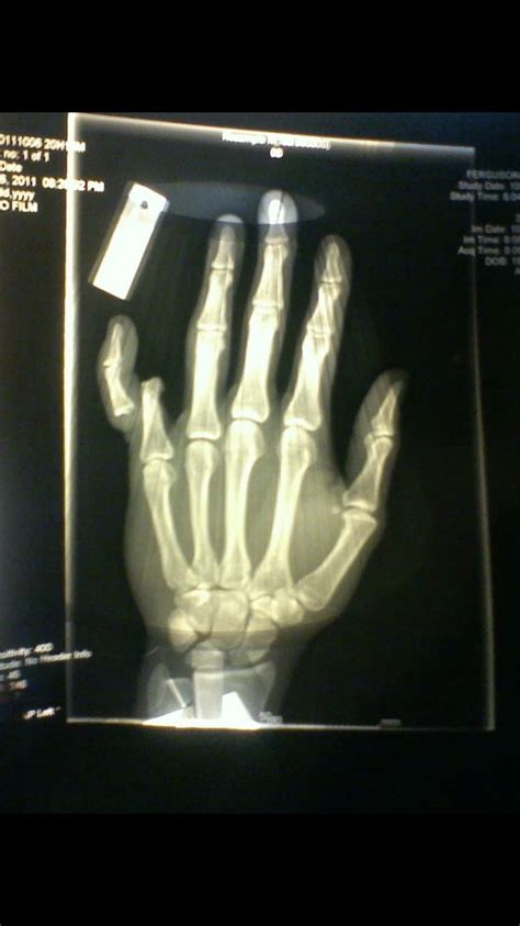 The X-ray of my left pinky finger after an open dislocation injury - 9GAG