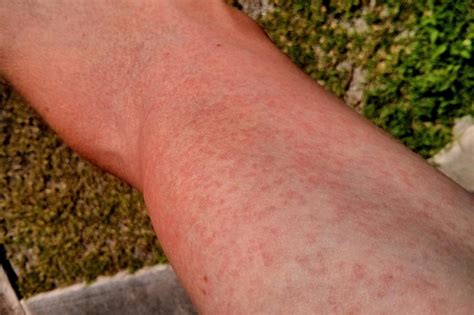 Maculopapular rash: Causes, treatment, and pictures