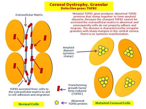 Corneal Dystrophy, Granular | Hereditary Ocular Diseases