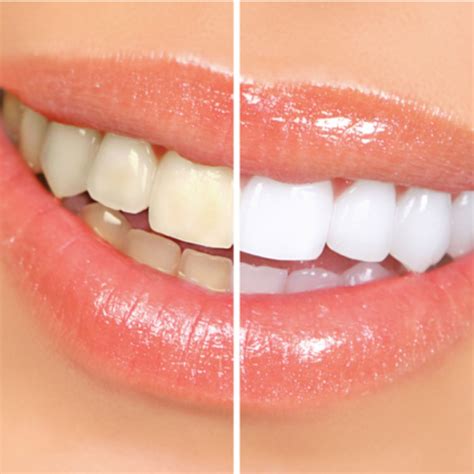 DIY Teeth Whitening: 5 Brilliant Tips for Whiter Teeth That Work – LIFESTYLE BY PS