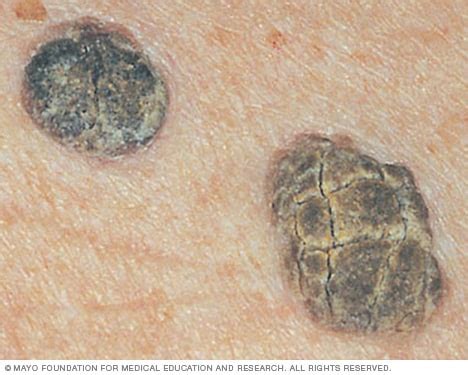 Seborrheic keratosis - Symptoms and causes - Mayo Clinic