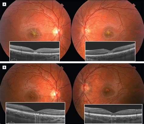 Foveal Injury From a Red Laser Pointer | Vision eye, Optometry, Optometry education