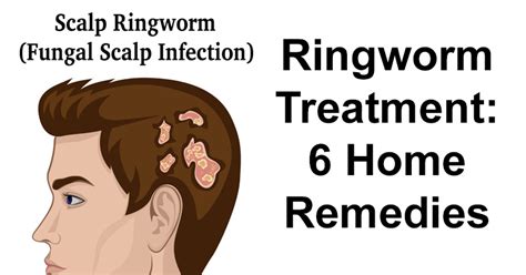 Best Home Remes For Scalp Ringworm - Homemade Ftempo