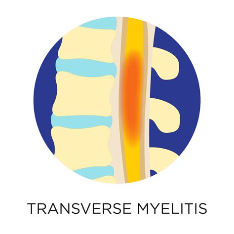 What Is Transverse Myelitis? | PainScale