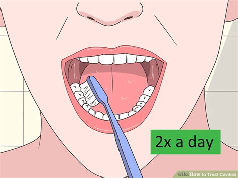 How to Treat Cavities (with Pictures) - wikiHow