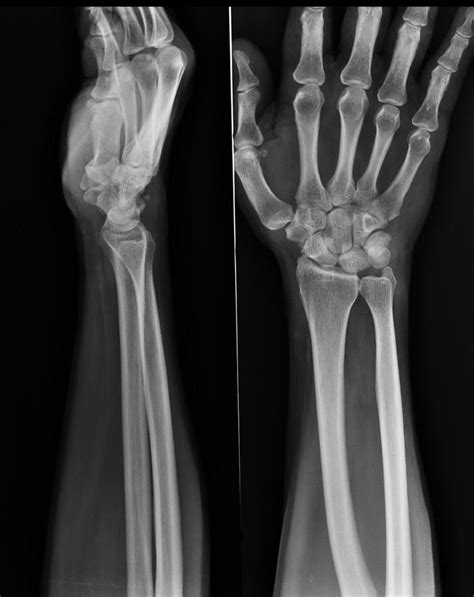 Triquetral fracture | Radiology Case | Radiopaedia.org | Radiology, Medical knowledge, Radiology ...