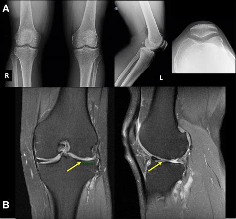 Tibial Plateau Mri