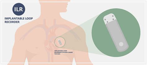 Implantable Loop Recorder Near Me in Downey, CA