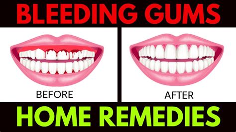 Bleeding Gums Home Remedies | Treat Your Bleeding Gums At Home - YouTube