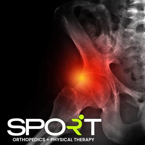 Hip Labral Tear | SPORT Orthopedics + Physical Therapy | Dallas