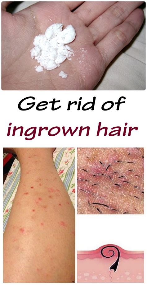 Get rid of ingrown hair - TOP 5 DIY