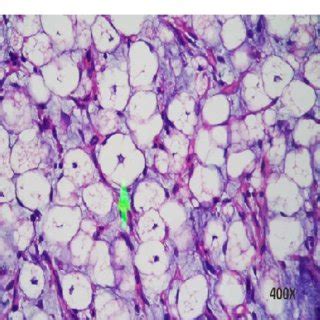 Lipoblasts, adipocytes arranged in lobules separated by fibrous septae ...