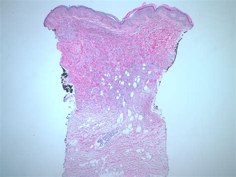 Dermatofibrosarcoma protuberans - Dermatology Advisor