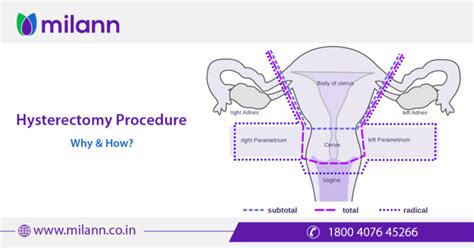 Milann : Best IVF Treatment Center | IVF Hospitals | Fertility Center ...