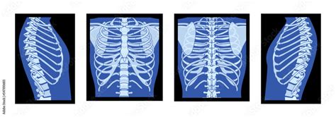 Set of X-Ray Rib cage Skeleton Human body - chest, vertebra, Bones adult people roentgen front ...