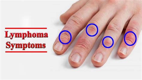 Lymphoma - Types, Causes, Symptoms, Diagnosis, Treatment