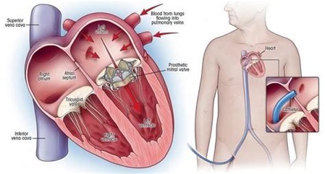 Everything you need to know about heart valve repair and replacement ...