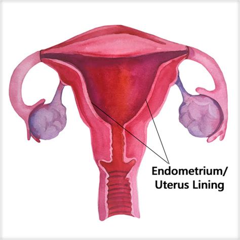 Endometrial Hyperplasia – Causes & Treatment | GAURI - Urogynecology Clinic