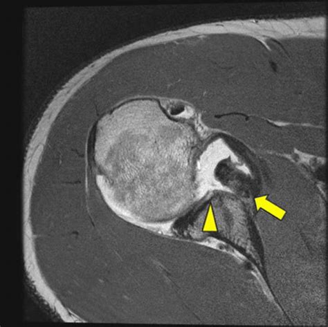 Bony Bankart lesion with a large displaced fragment of the anterior... | Download Scientific Diagram