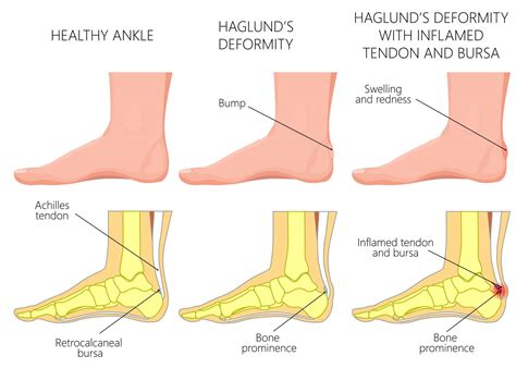 Insertional Achilles Tendonitis | Insertional Achilles Tendinopathy