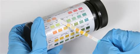 Glucose urine test