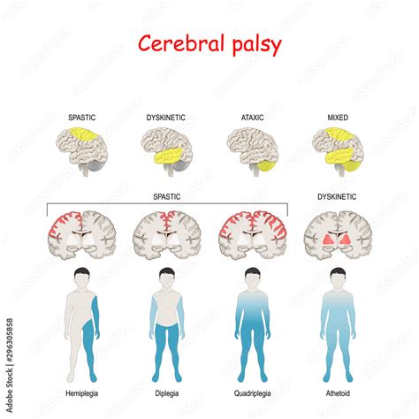 Cerebral palsy. Human brain with area Mixed, Ataxic, Dyskinetic, and ...