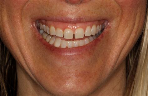 smile close up teeth apart - Centreville Dental Wellness Center