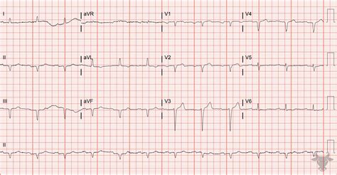 Poor R-wave Progression | ECG Stampede