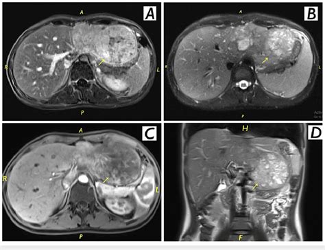 Abdominal MRI findings confirm hepatocellular carcinoma Abdominal MRI ...