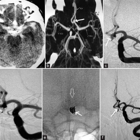 CT scan shows subarachnoid hemorrhage predominantly in the anterior... | Download Scientific Diagram