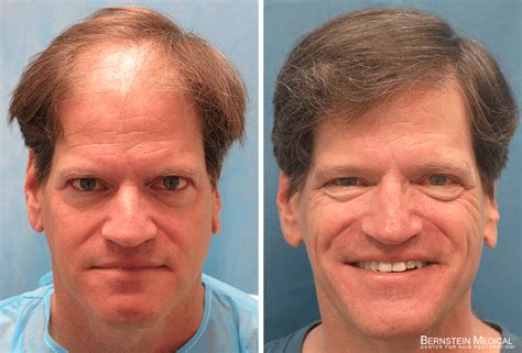 Patient TRT | Bernstein Medical - Center for Hair Restoration