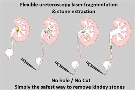 Kidney Stone Laser Surgery - Advanced Medical Surgery News | Modern Care Clinics | Blog