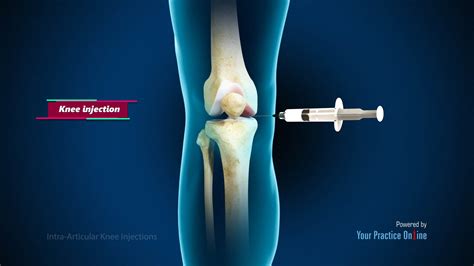 Intra-articular Knee Injections Video | Medical Video Library