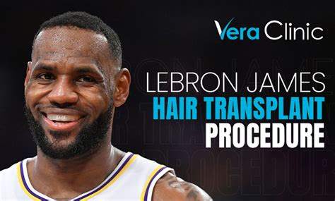 LeBron James Hair Transplant - Vera Clinic