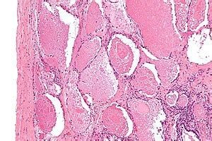 Pulmonary alveolar proteinosis - Libre Pathology