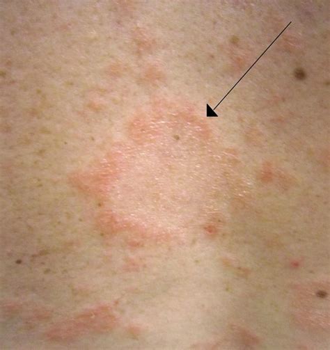 Pityriasis Rosea | LaptrinhX / News