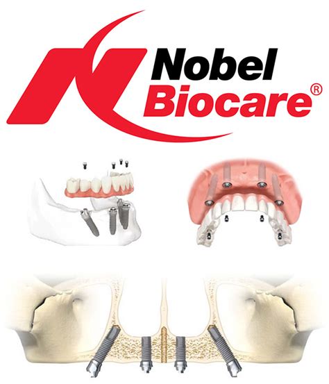 Why we use Nobel Biocare dental implants? - Tribeca Advanced Dentistry