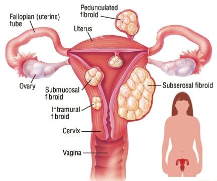 apa itu fibroid - Molly Cameron