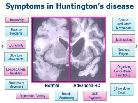 Huntington’s disease