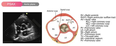 Aortic valve sclerosis with mild aortic regurgitation | doctorvisit