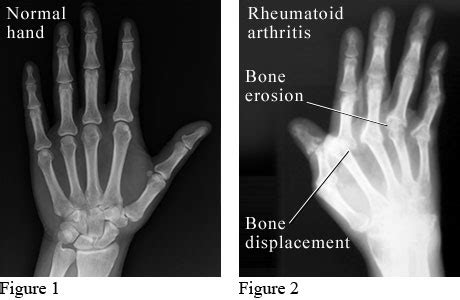 X-Ray of Rheumatoid Arthritis in the Hands | University of Michigan Health System