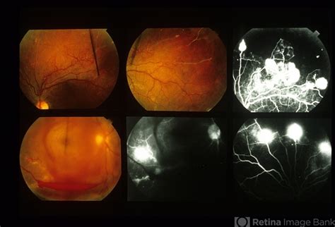 Eales Disease - Retina Image Bank