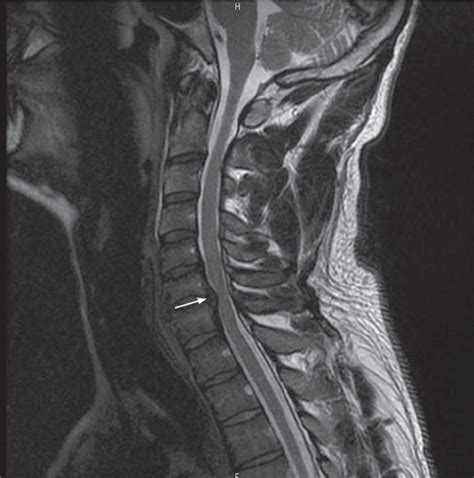 Healthy Cervical Spine Mri | Radiology, Mri, Ct scan