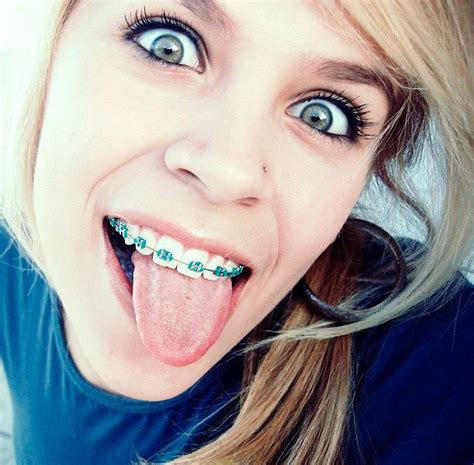 Braces: People With Blue Braces