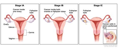 Treatment of Ovarian Epithelial, Fallopian, & Peritoneal Cancers - NCI