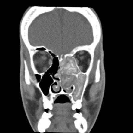 Allergic fungal sinusitis | Radiology Reference Article | Radiopaedia.org