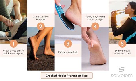 Cracked Heels: Causes, Prevention Tips & Treatment Options – Solvblem