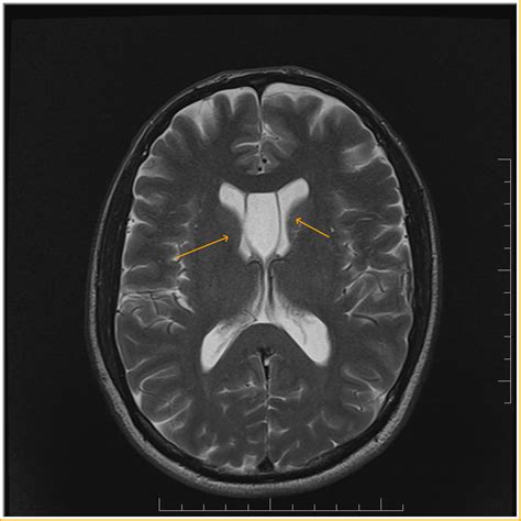 Cavum septum pellucidum-MRI - Sumer's Radiology Blog