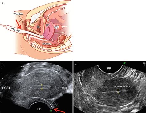 The use of Color Doppler Ultrasound with Transvaginal probe